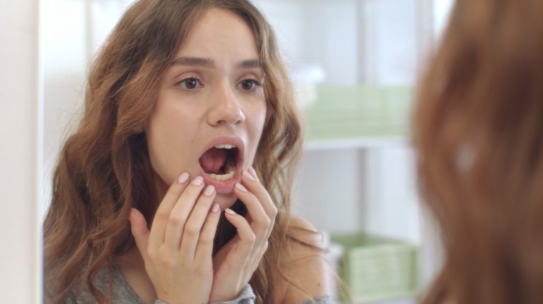Understanding White Spots on Gums woman looking in the mirror