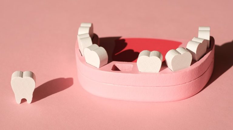 Ways to Prevent Tooth Decay: Tips for Healthy Teeth model of mouth missing tooth